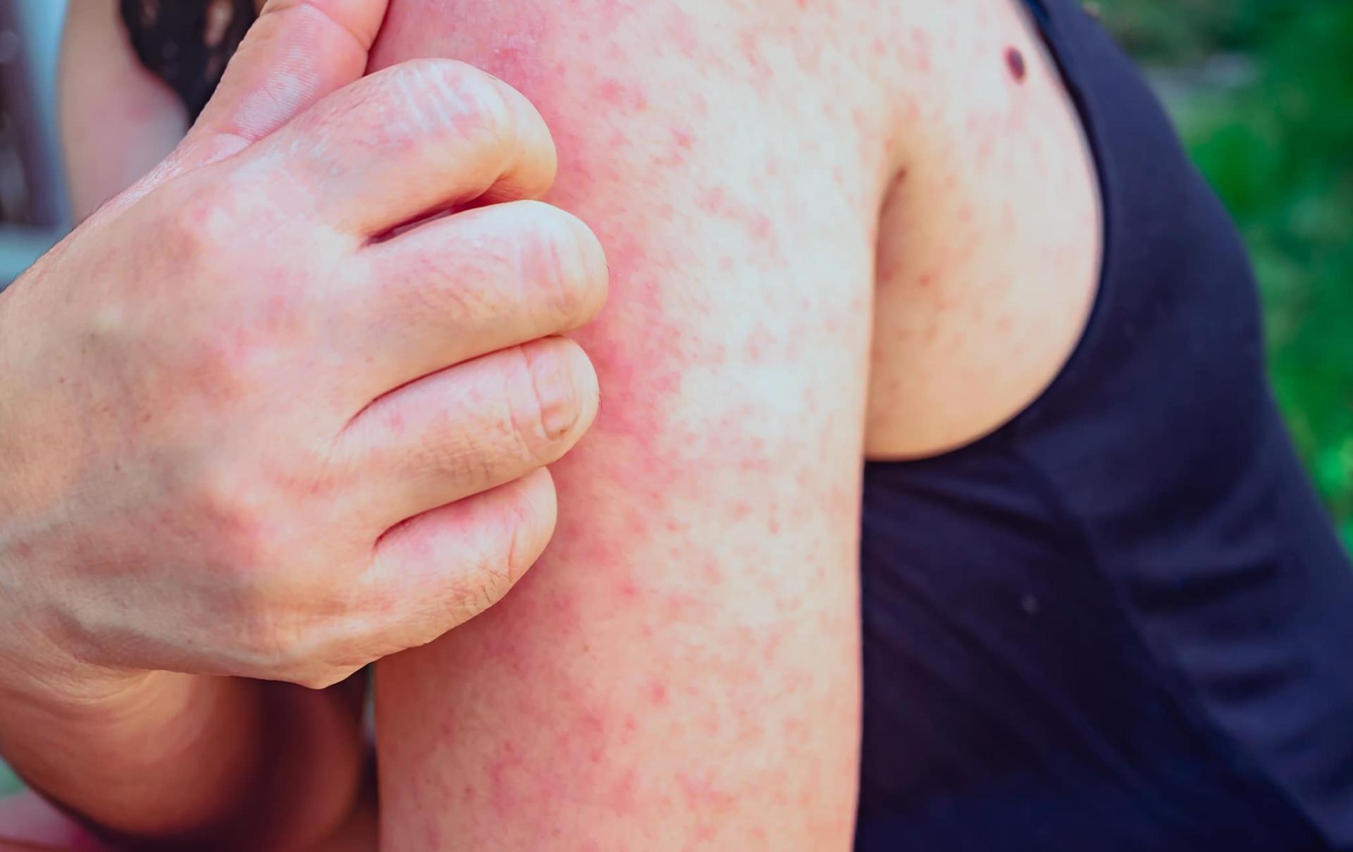 Secretaria de Saúde de Paranatinga emite alerta sobre suspeita de caso de sarampo